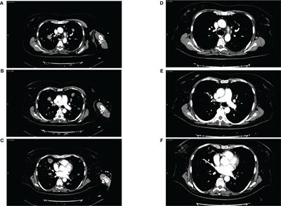 Pembrolizumab plus lenvatinib in advanced endometrial cancer: case report and systematic review of lung toxicity